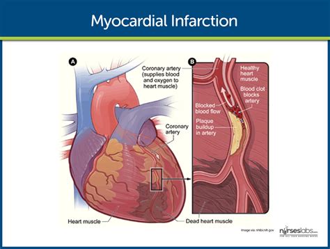 does myocardial ischemia affect blood flow.